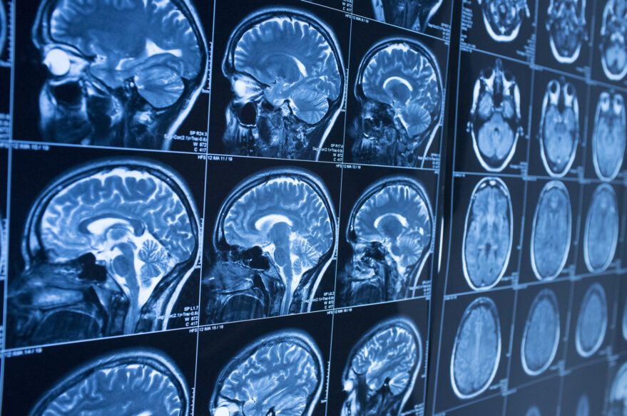 Blunt Force Head Trauma – Cause and Effect